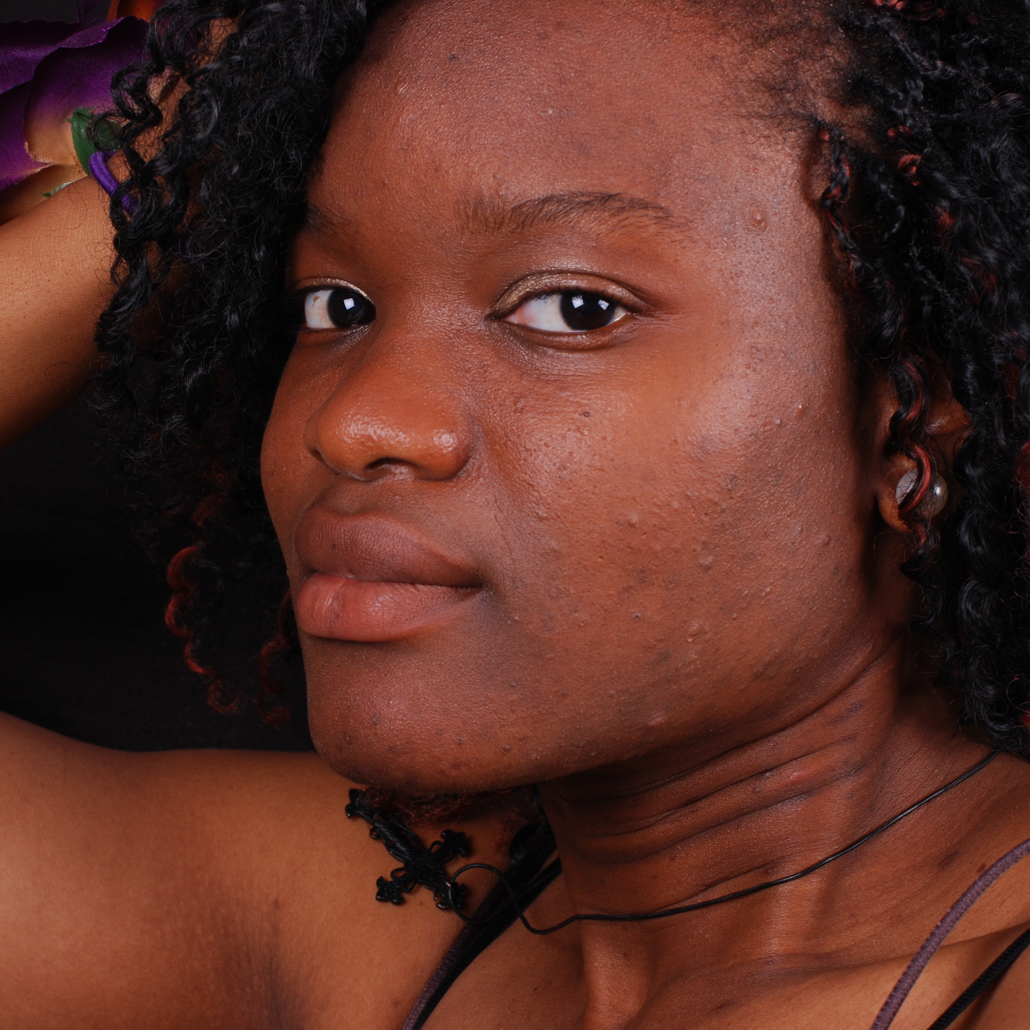 Why You Keep Having Acne Scars and Dark Spots